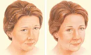 brow lift coronal incision brow lift coronal incision