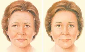 brow lift endoscopic incision brow lift endoscopic incision