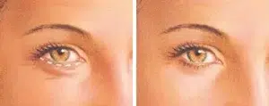eyelid surgery lower eyelid incision eyelid surgery lower eyelid incision