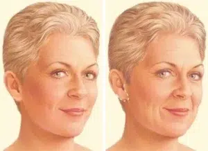 facelift surgery limited incision.jpg facelift surgery limited incision.jpg