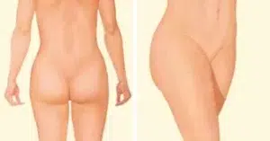 liposuction after buttock thighs stomach liposuction after buttock thighs stomach