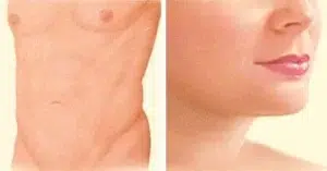 liposuction after stomach breasts chin liposuction after stomach breasts chin