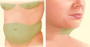 liposuction before stomach breasts chin liposuction before stomach breasts chin