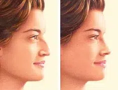 rhinoplasty procedure before after.jpg rhinoplasty procedure before after.jpg