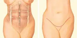 tummy tuck incision front abdomen sutures tummy tuck incision front abdomen sutures
