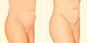 tummy tuck side before after tummy tuck side before after