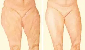 medial thigh lift incision.jpg medial thigh lift incision.jpg