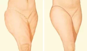 outer thigh lift incision.jpg outer thigh lift incision.jpg