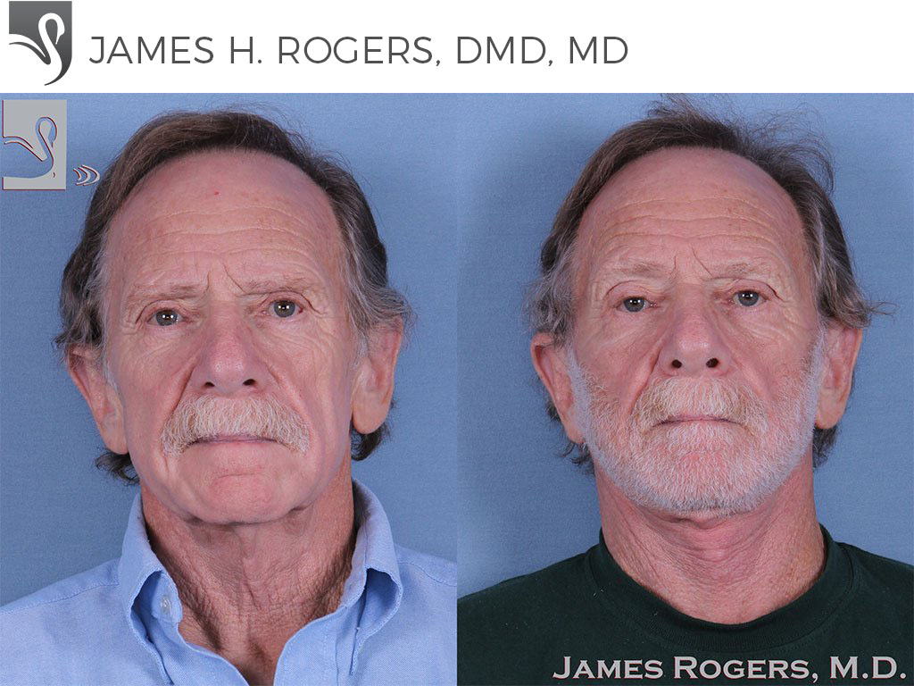 Before and After Image: Face Lift Case #10587 - front