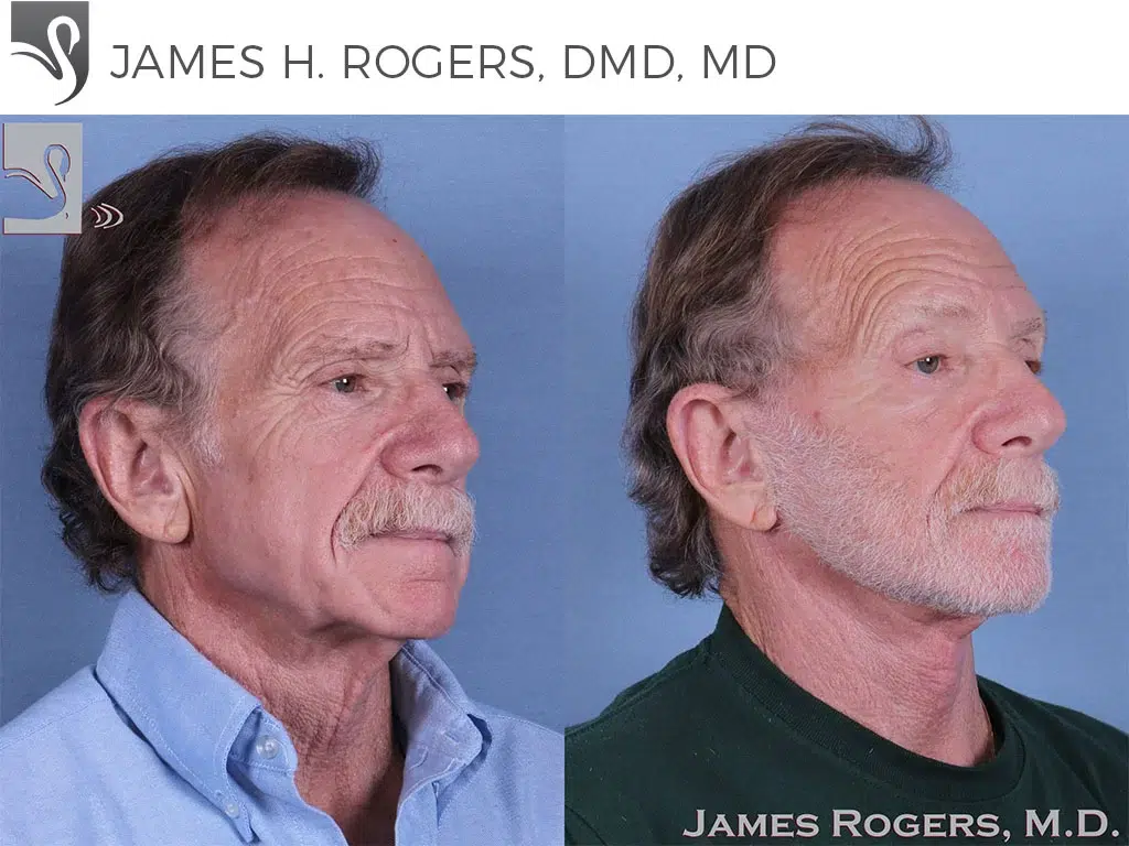 Before and After Image: Face Lift Case #10587 - right-front-oblique