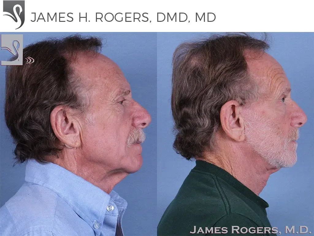Before and After Image: Face Lift Case #10587 - right-side