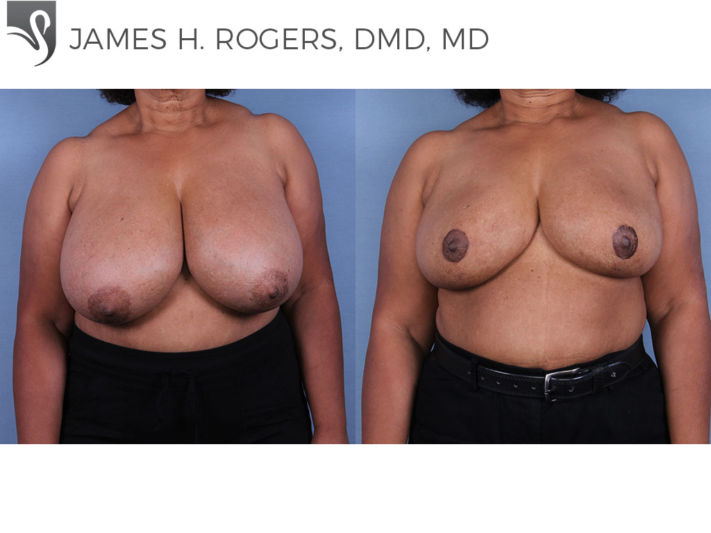Before and After Image: Female Breast Reduction Case #10899 - front
