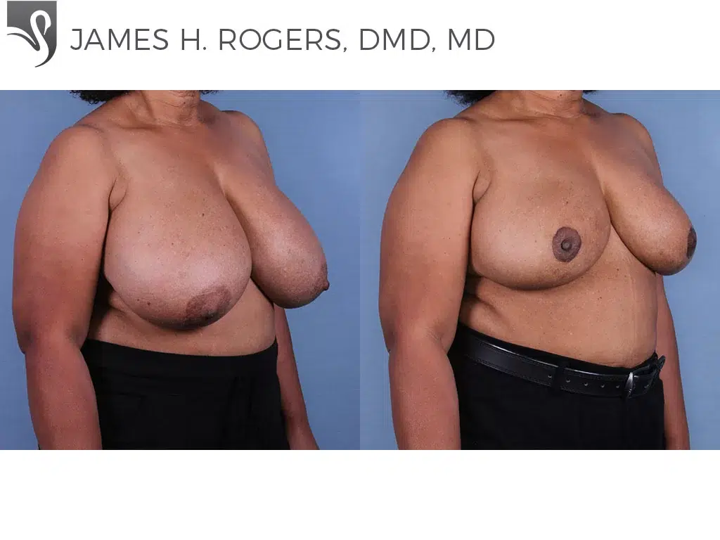 Before and After Image: Female Breast Reduction Case #10899 - right-front-oblique