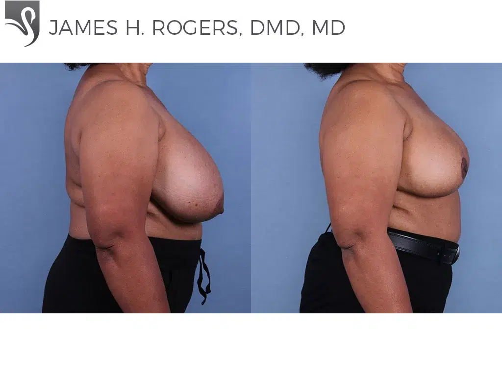 Before and After Image: Female Breast Reduction Case #10899 - right-side