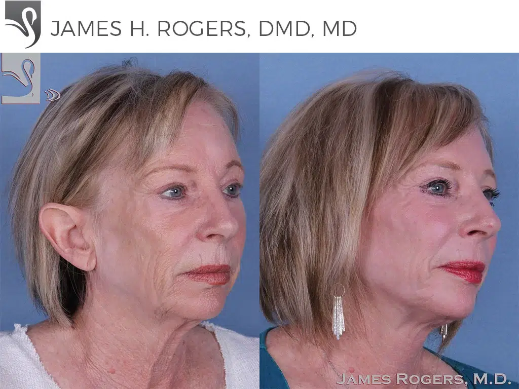 Before and After Image: Face Lift Case #11070 - right-front-oblique