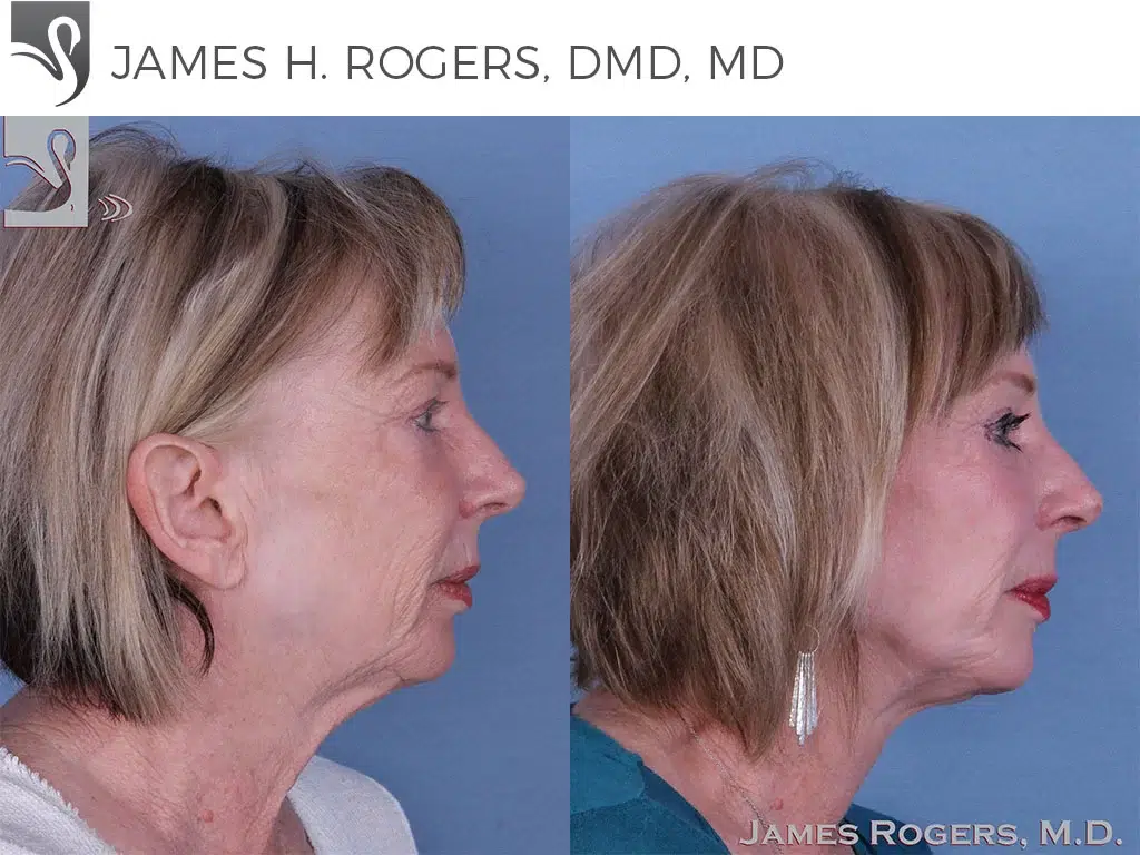 Before and After Image: Face Lift Case #11070 - right-side