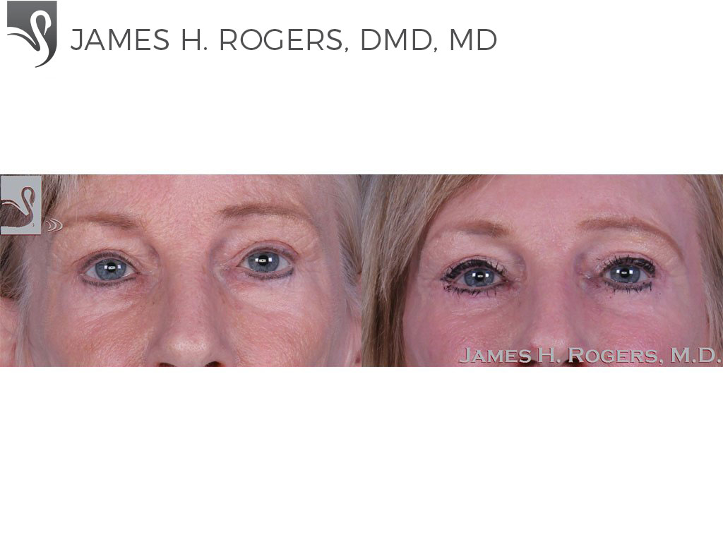 Before and After Image: Eyelid Surgery Case #11070 - front