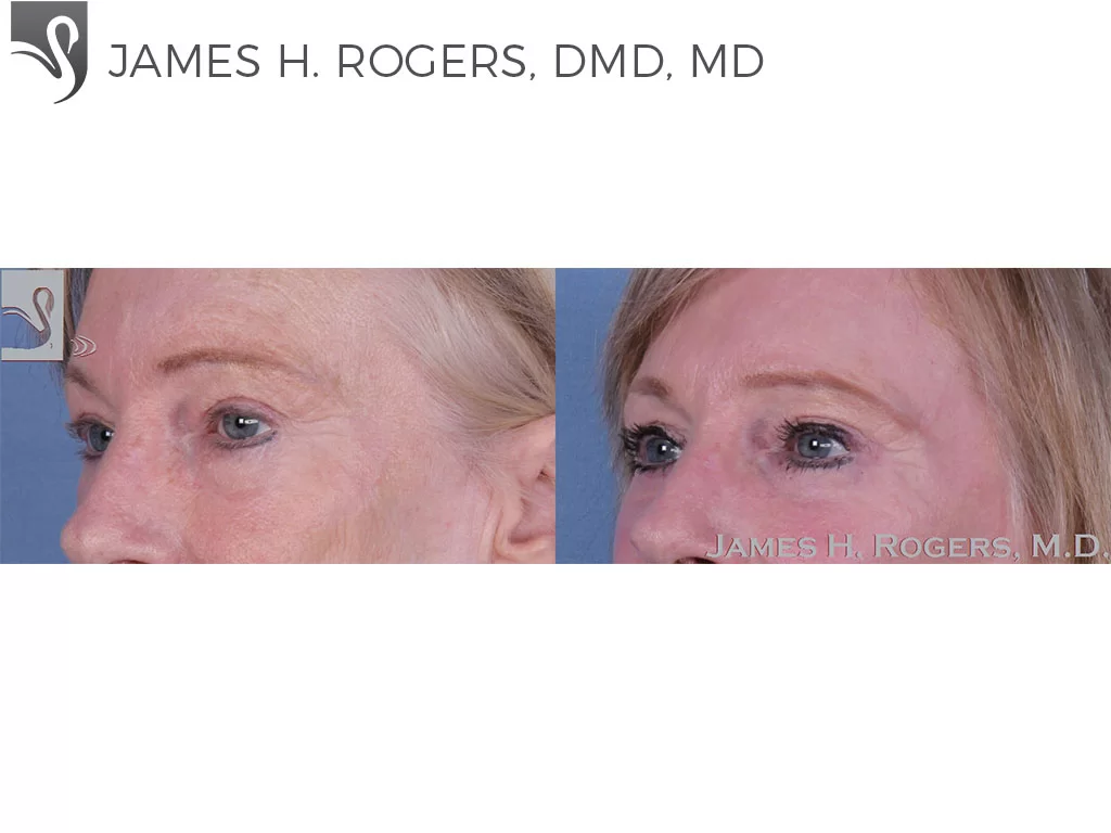 Before and After Image: Eyelid Surgery Case #11070 - left-front-oblique