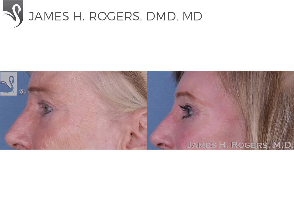 Before and After Image: Eyelid Surgery Case #11070 - left-side