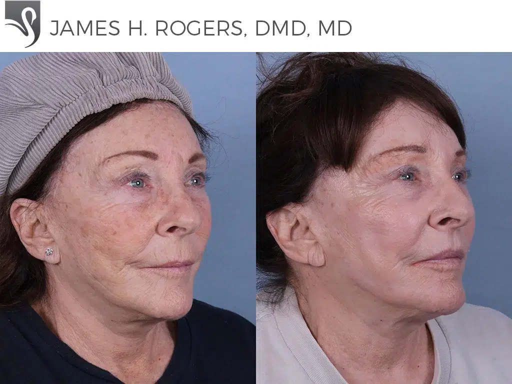 Before and After Image: Face Lift Case #11564 - right-front-oblique