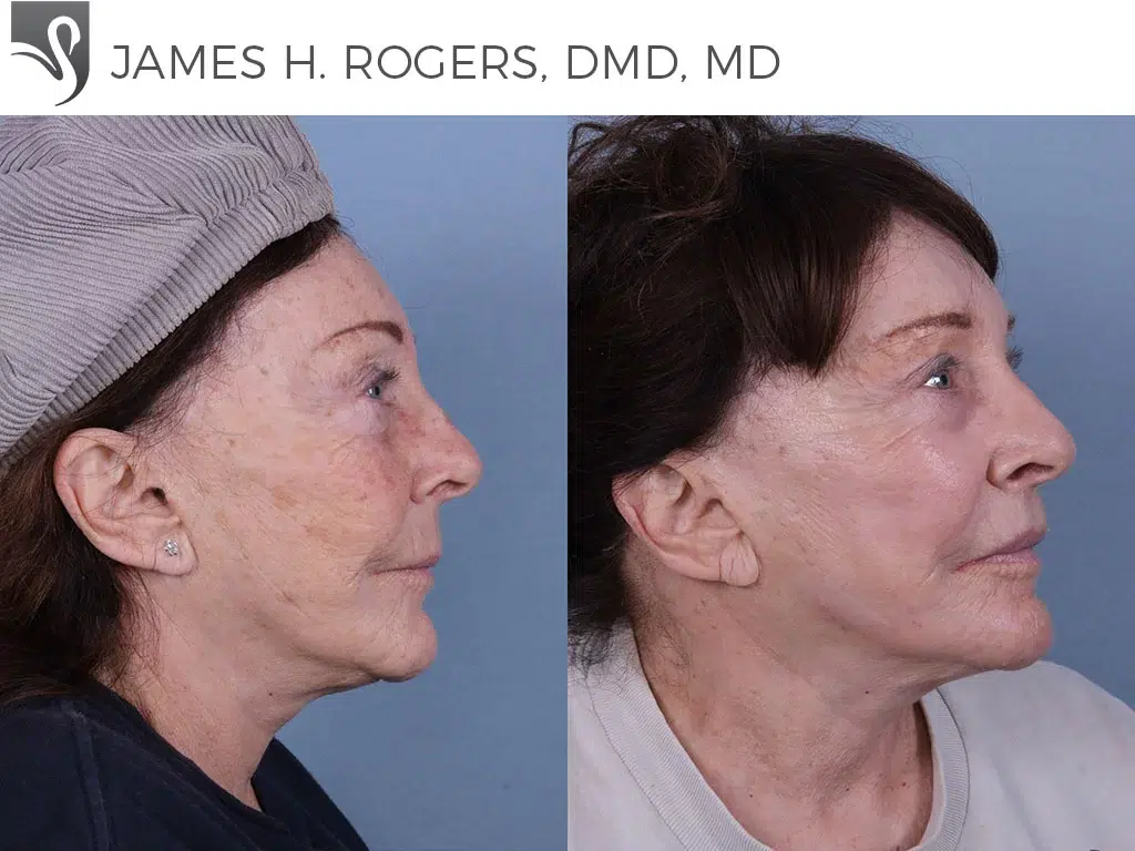 Before and After Image: Face Lift Case #11564 - right-side