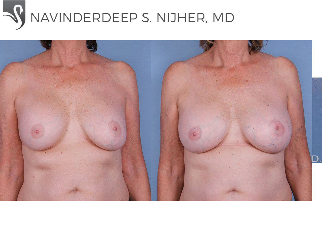 Before and After Image: Breast Revisions Case #12241 - front