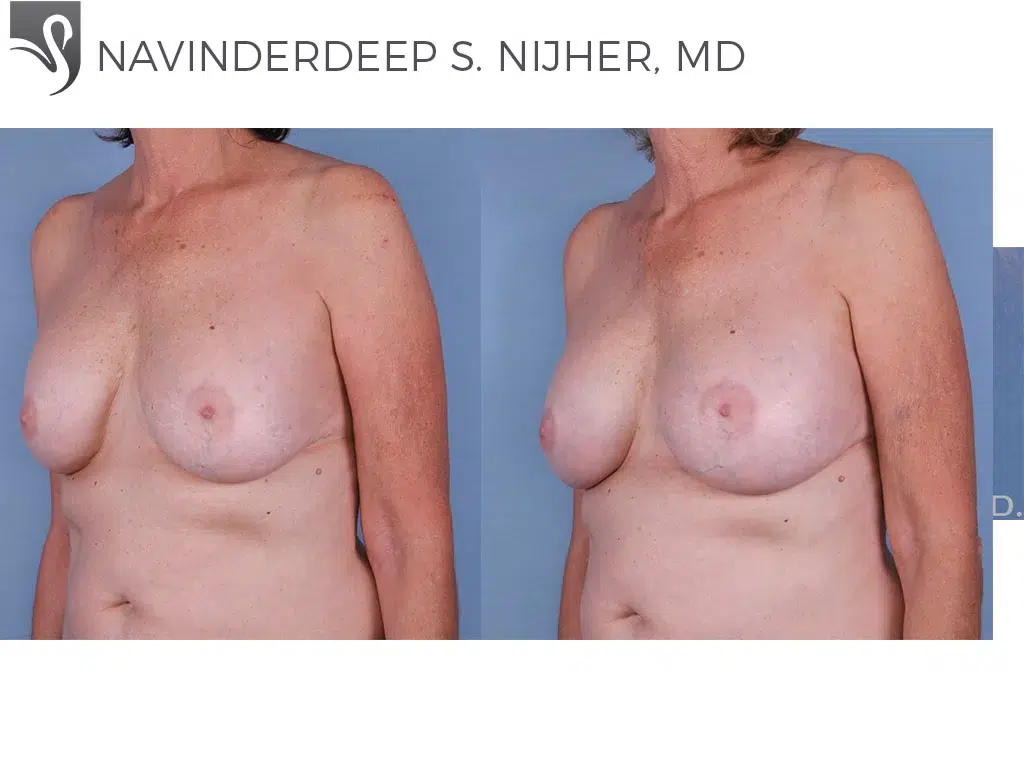 Before and After Image: Breast Revisions Case #12241 - left-front-oblique