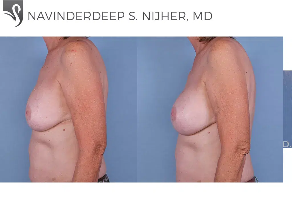 Before and After Image: Breast Revisions Case #12241 - left-side