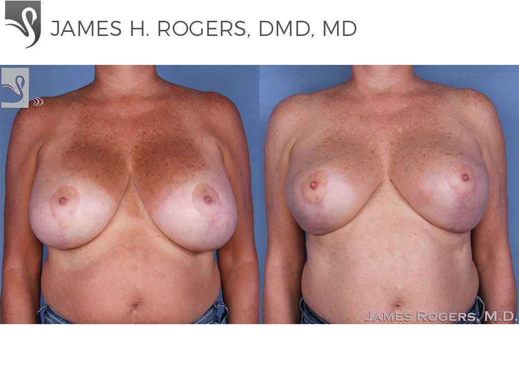 Before and After Image: Female Breast Reduction Case #13784 - front