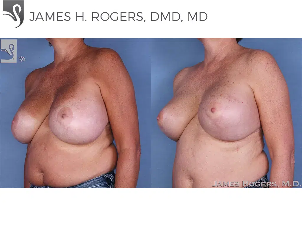 Before and After Image: Female Breast Reduction Case #13784 - left-front-oblique