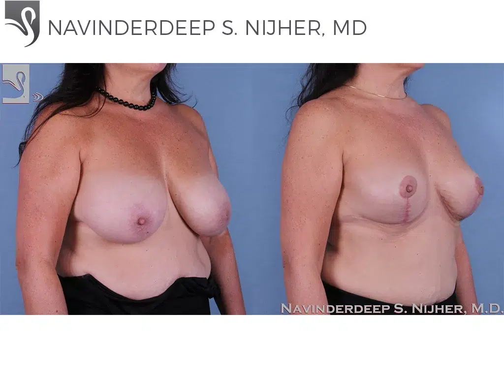 Before and After Image: Breast Lift (Mastopexy) Case #14090 - right-front-oblique