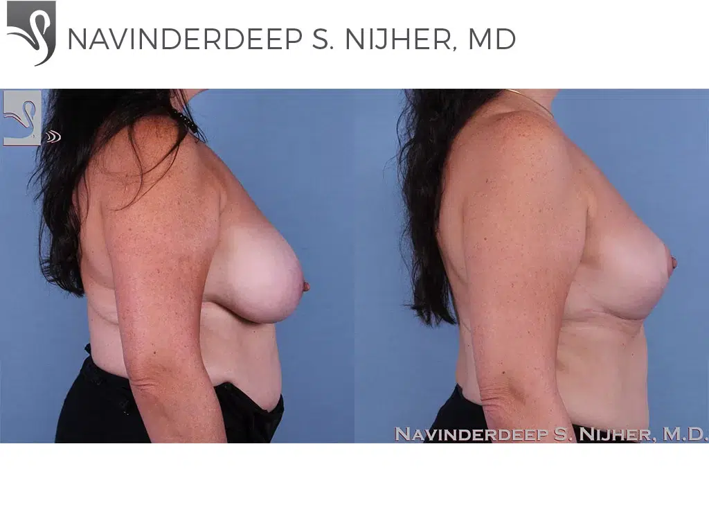 Before and After Image: Breast Lift (Mastopexy) Case #14090 - right-side