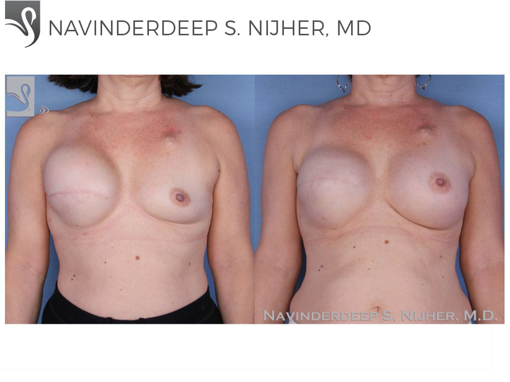 Before and After Image: Breast Reconstruction Case #15749 - front