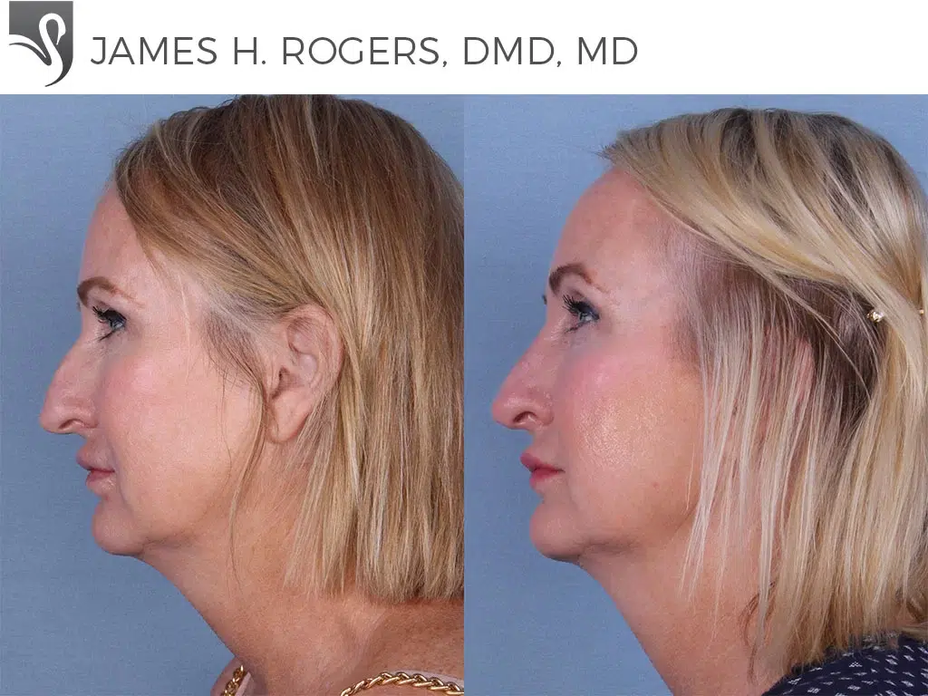 Before and After Image: Rhinoplasty Case #16792