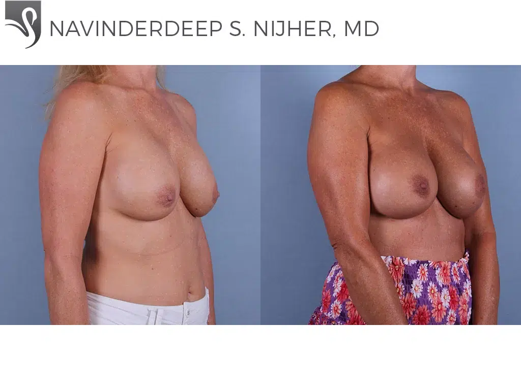 Before and After Image: Breast Revisions Case #17081 - right-front-oblique