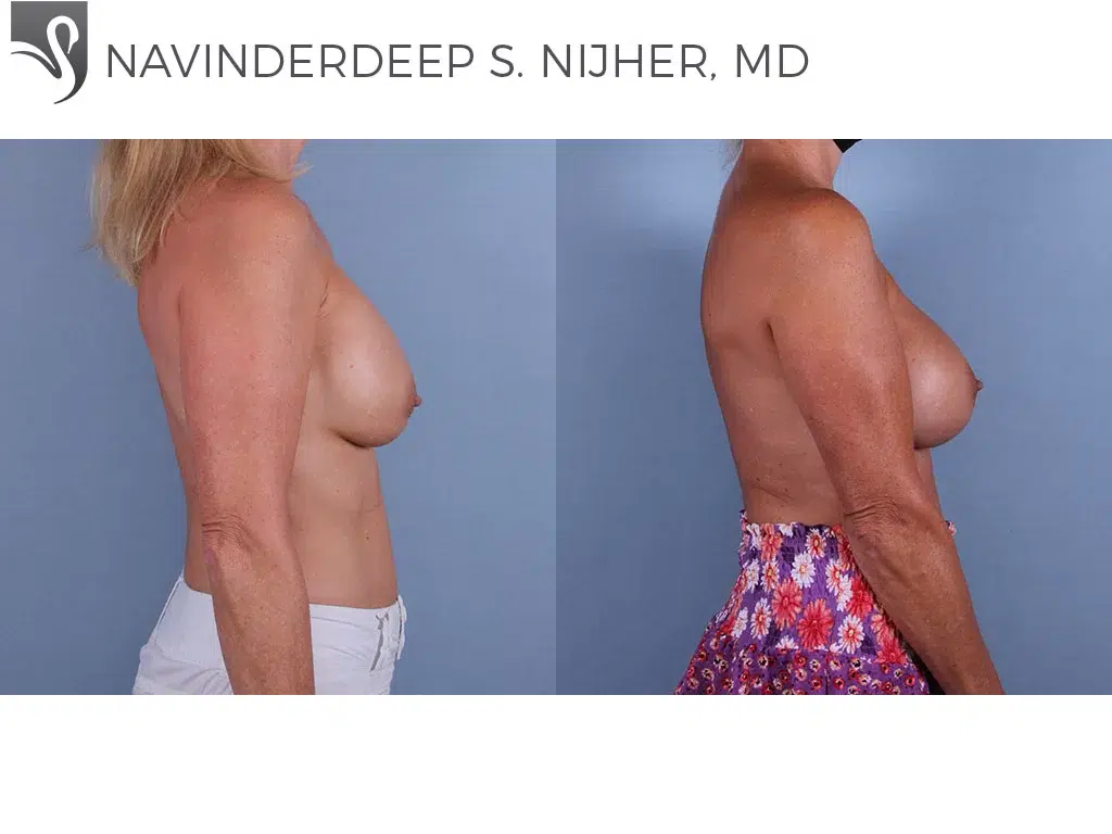 Before and After Image: Breast Revisions Case #17081 - right-side