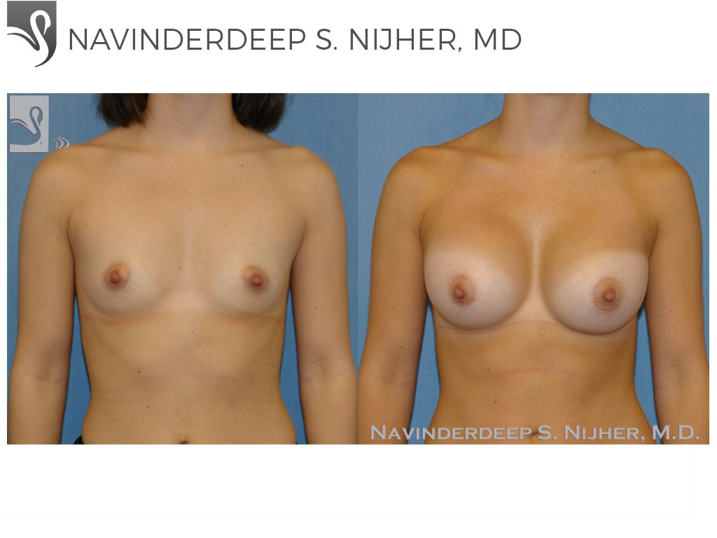 Before and After Image: Breast Augmentation Case #17095 - front