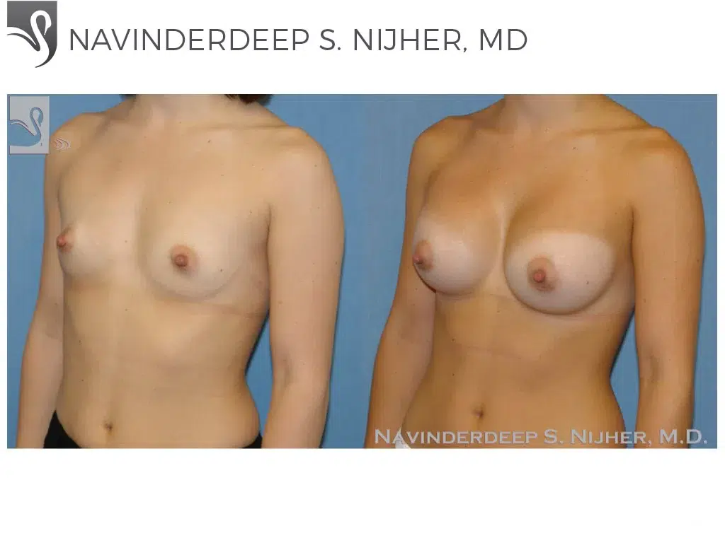 Before and After Image: Breast Augmentation Case #17095 - left-front-oblique