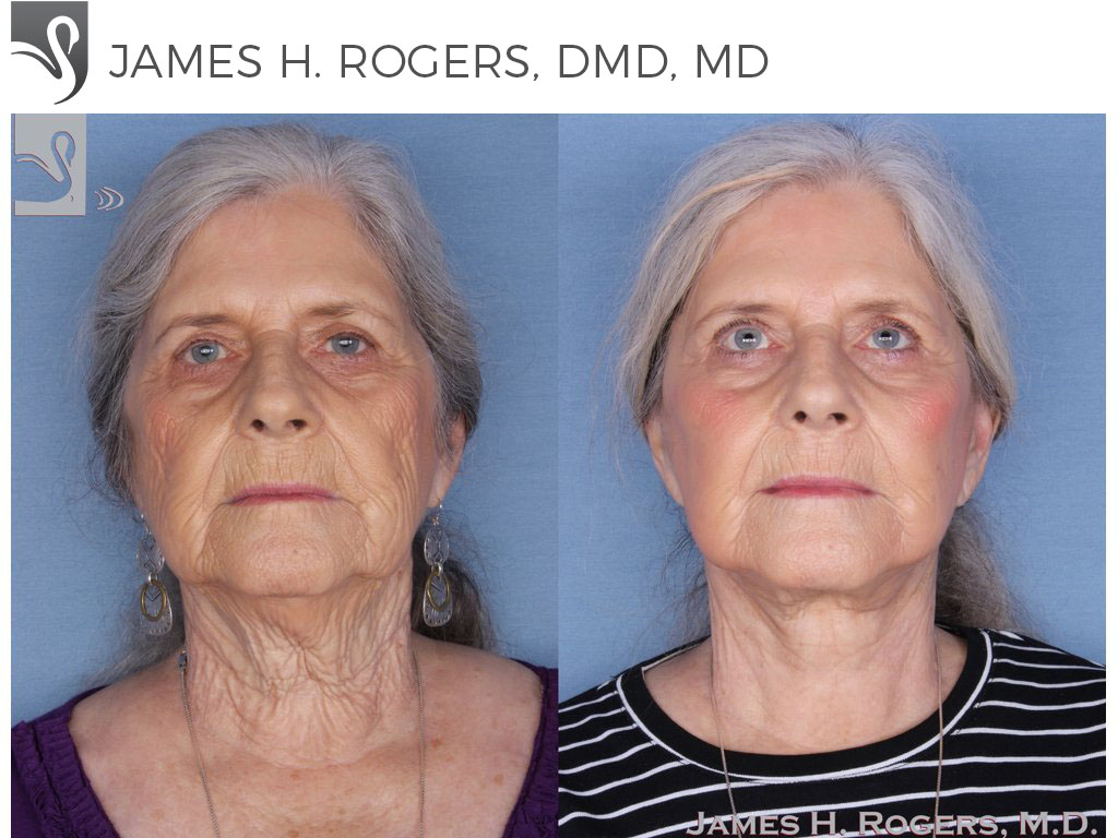 Before and After Image: Face Lift Case #17599 - front