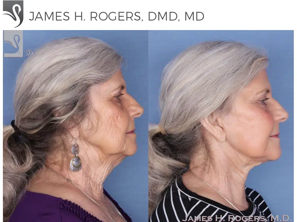 Before and After Image: Face Lift Case #17599 - right-side