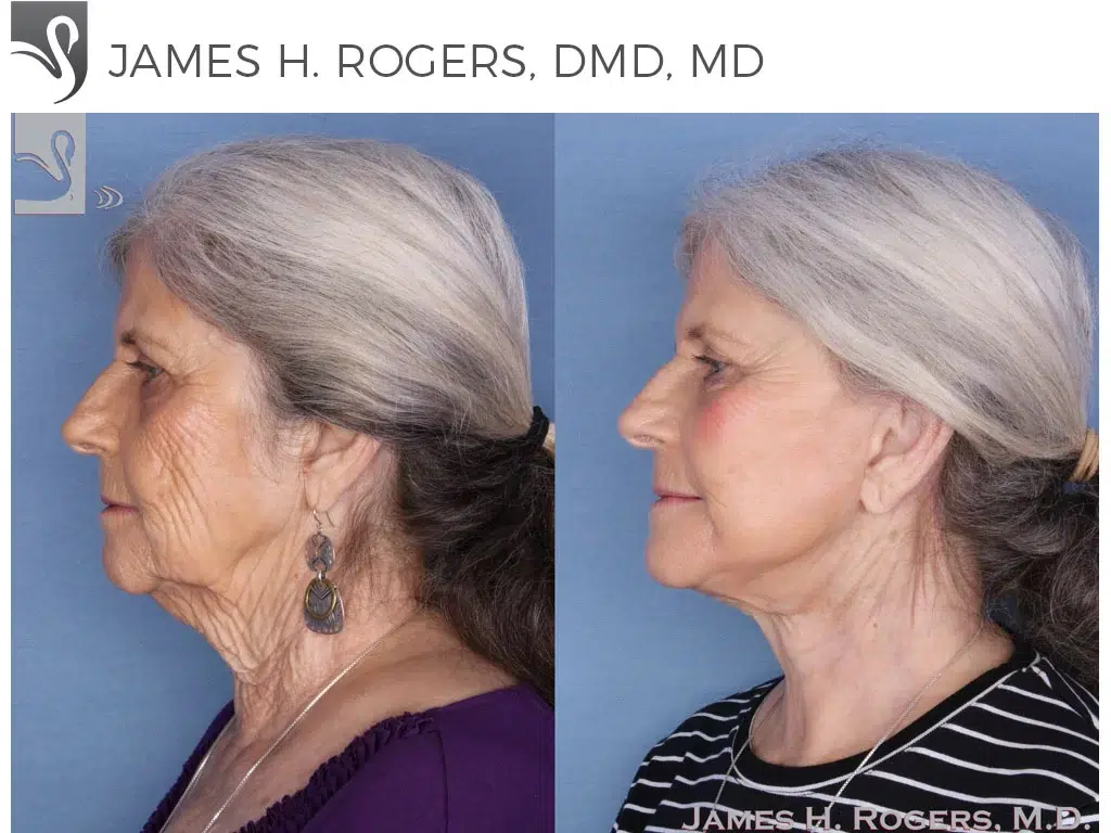 Before and After Image: Face Lift Case #17599 - left-side
