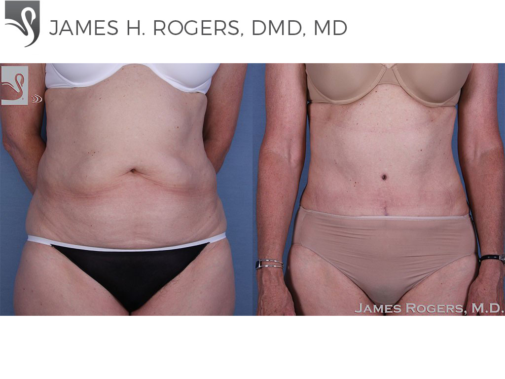 Before and After Image: Abdominoplasty (Tummy Tuck) Case #17972 - front