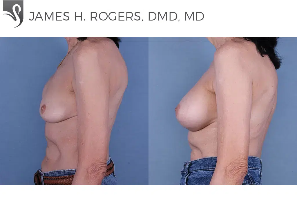 Before and After Image: Breast Reconstruction Case #19322 - left-side