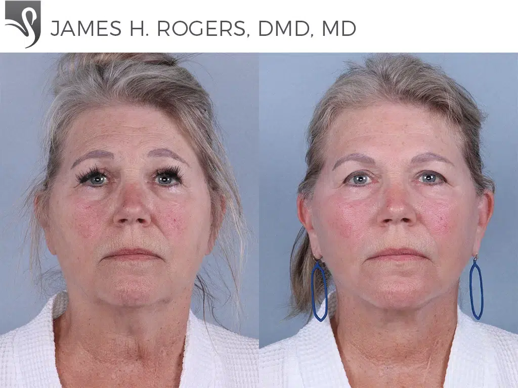 Before and After Image: Face Lift Case #19367 - front