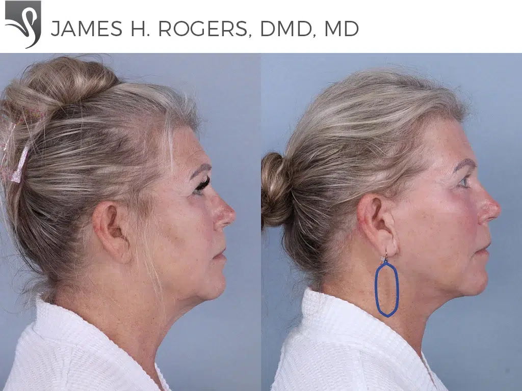 Before and After Image: Face Lift Case #19367 - right-side