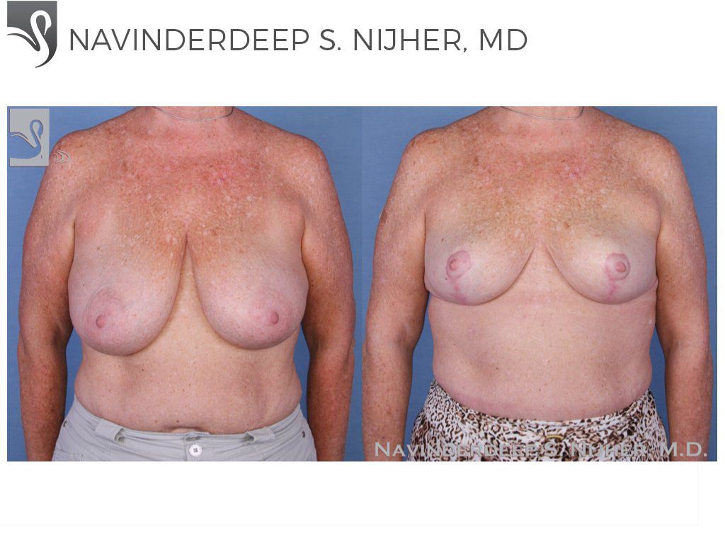 Before and After Image: Female Breast Reduction Case #19467 - front