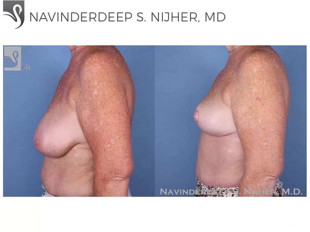 Before and After Image: Female Breast Reduction Case #19467 - left-side