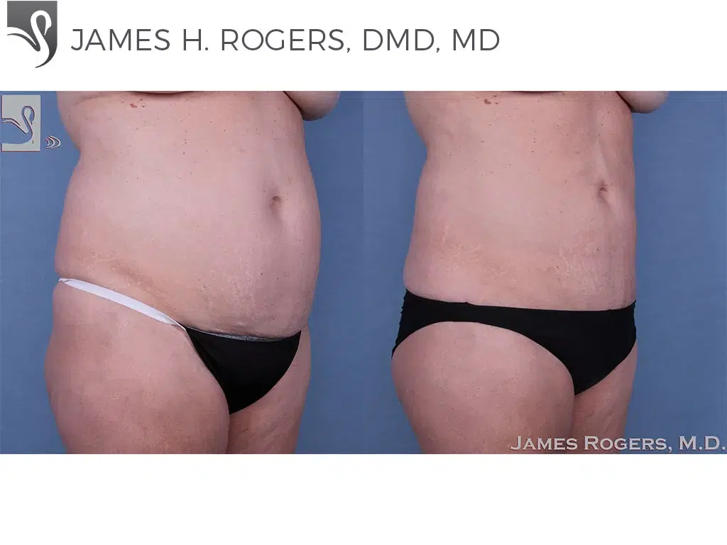Before and After Image: Liposuction Case #19613 - right-front-oblique