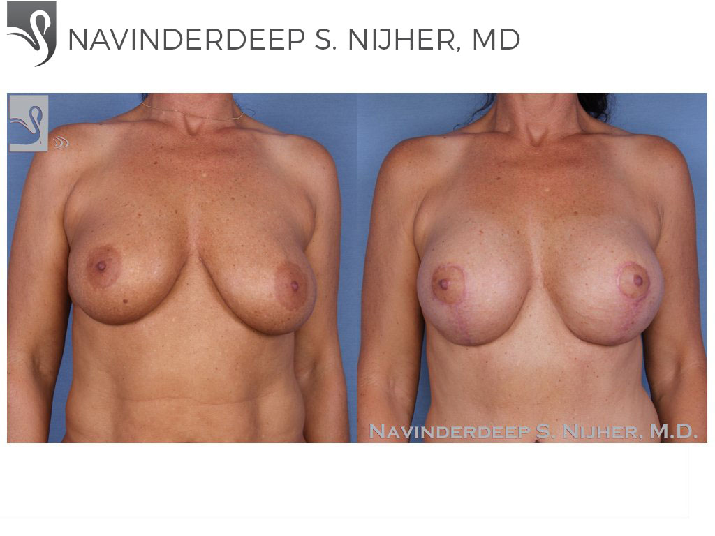 Before and After Image: Breast Revisions Case #20729 - front