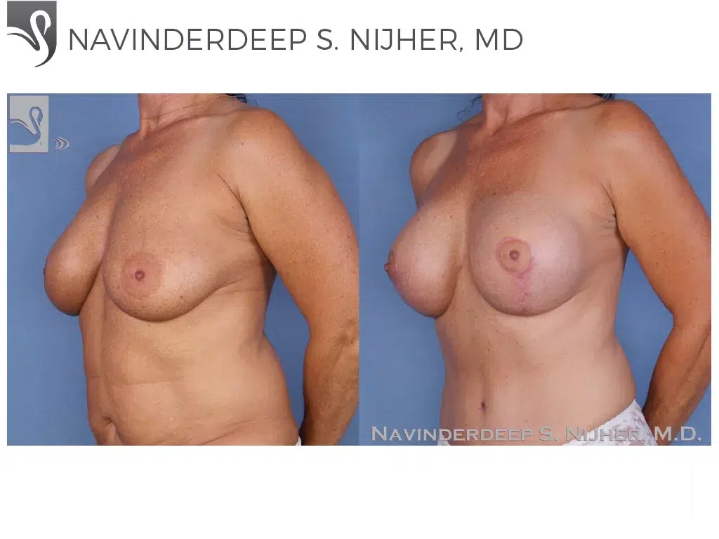 Before and After Image: Breast Revisions Case #20729 - left-front-oblique